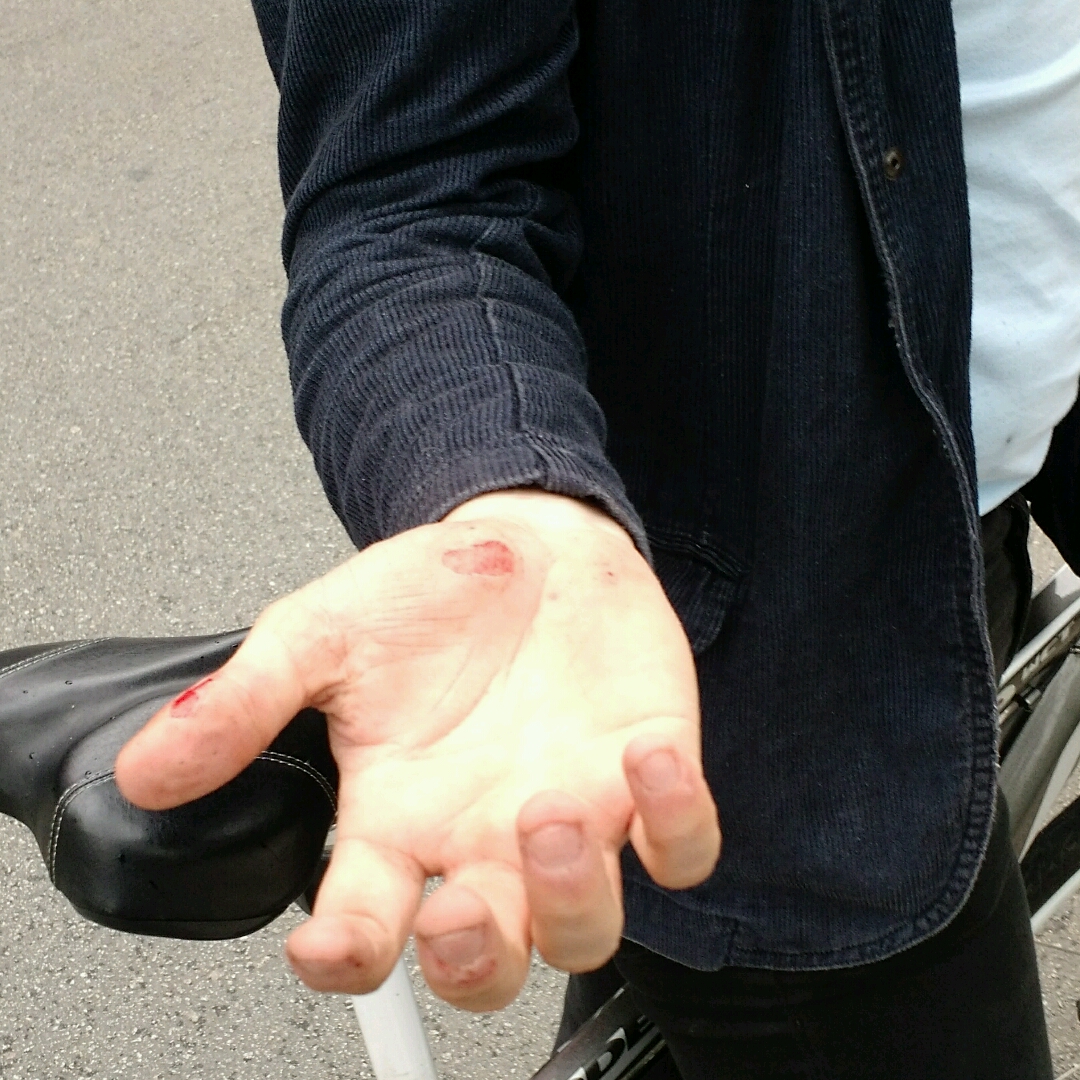 A hand with scratches